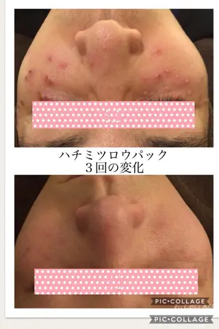 ニキビ・肌質改善専門 ♡人生が変わるサロンのエステ・リラクイメージ