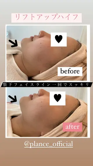 フェイシャル専門 肌質改善/プランスのエステ・リラクイメージ