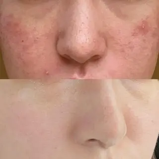 学生ニキビ改善🍀 優しい肌質改善のエステ・リラクイメージ