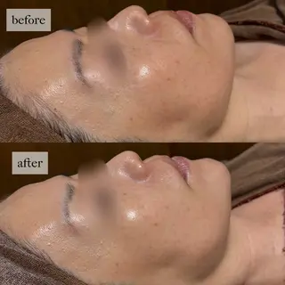 HINANO矢場町店【ヒナノ】所属・脱毛/肌改善🌿 HINANO 村田のエステ・リラクイメージ