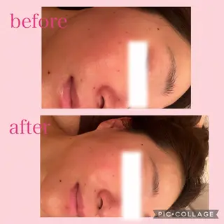 3/25迄ハーブ ピーリングBloomのエステ・リラクイメージ