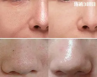 全身脱毛＆VIO脱毛 紹介率№1♪リナ♪のエステ・リラクイメージ