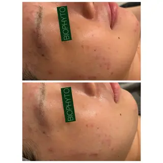 ☆痩身/小顔☆ ハイパーナイフexのエステ・リラクイメージ