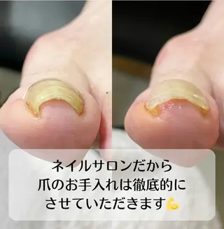 ネイル 深爪・巻き爪 専門サンセリテのネイルデザイン