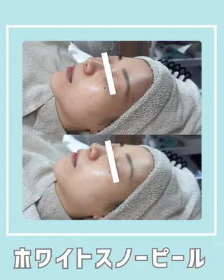 |ピーリング・毛穴| soina神楽坂のエステ・リラクイメージ