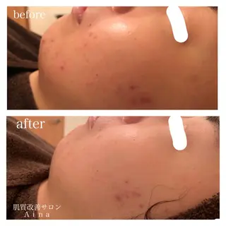 ロング ヘアアレンジ キッズ ネイル マツエク・マツパ ニキビ跡専門サロン Ａｉｎａのエステ・リラクイメージ