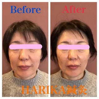 HARIKA鍼灸所属・HARIKA 鍼灸のその他イメージ