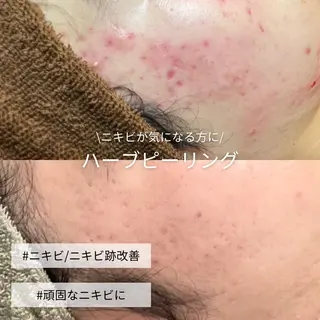 EST BEAUTY所属・顔ワックス脱毛/ ハーブピーリングのエステ・リラクイメージ