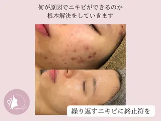 肌質改善/ブライダル 水上百華のエステ・リラクイメージ