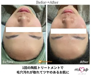 Meupニキビ専門店 背中/ハーブ/肌管理のその他イメージ