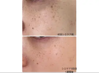 ピーリングケア 🤍moekoのエステ・リラクイメージ