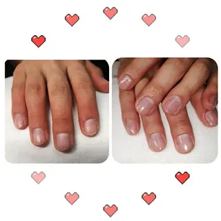 ネイル フィルイン、長さ出し 深爪矯正のネイルデザイン