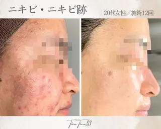 ピーリング×肌管理 THREETHREEのエステ・リラクイメージ