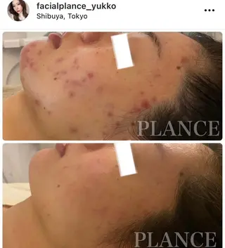 フェイシャル専門 肌質改善/プランスのエステ・リラクイメージ