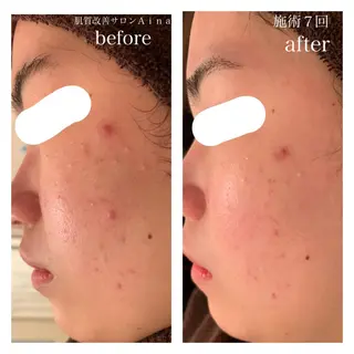 ミディアム パーマ キッズ ネイル マツエク・マツパ ニキビ跡専門サロン Ａｉｎａのエステ・リラクイメージ