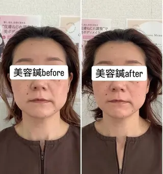 hari salon de off 美容鍼灸×小顔整体【ハリサロンドオフ】所属・美容鍼灸×小顔整体♡ ハリサロンドオフ堺東のエステ・リラクイメージ