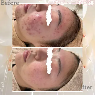 ニキビ&跡改善サロン オーナー光木のエステ・リラクイメージ