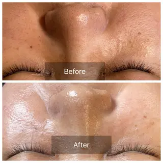 ハーブピーリング Lanaのエステ・リラクイメージ