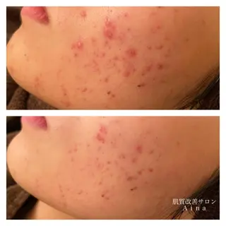 ロング カラー パーマ ヘアアレンジ メンズ キッズ ネイル マツエク・マツパ ニキビ跡専門サロン Ainaのエステ・リラクイメージ