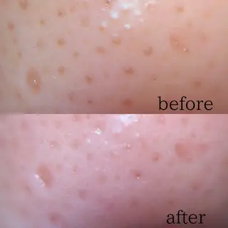 毛穴ケア/毛穴診断/ 毛穴洗浄〔心斎橋〕のエステ・リラクイメージ