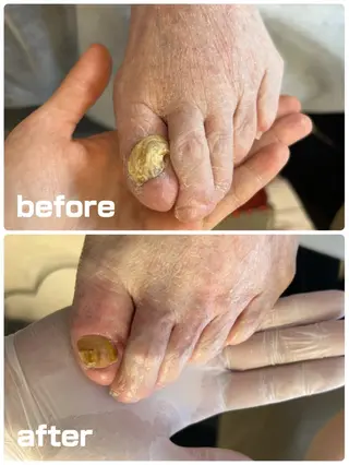 巻き爪フットケアサロンKotori所属・フットケアサロン Kotoriのその他イメージ