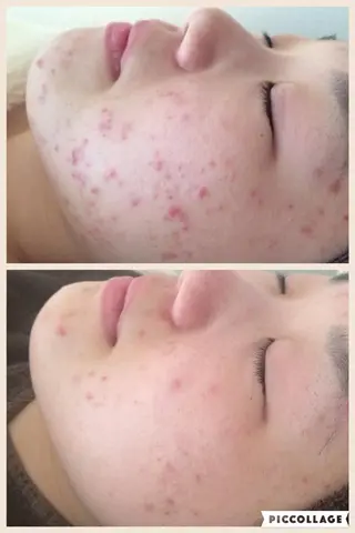 ニキビ跡改善専門🔥 医療にはできない改善のエステ・リラクイメージ