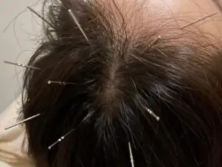 アロマ･美容鍼･カッ ピング「麗」鍼灸院のエステ・リラクイメージ