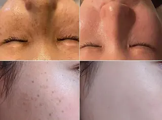 顔脱毛＆毛穴＆ニキビ 優良№1♪ヒロコ♪のエステ・リラクイメージ