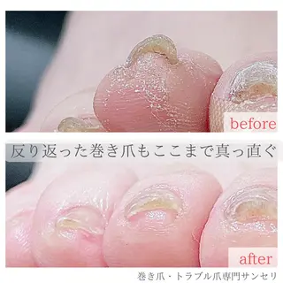 ネイル 深爪・巻き爪 専門サンセリテのネイルデザイン