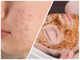 シミケア/ハーブピーリング/脱毛/小顔フェイシャル/ハーブ温浴　LAULEA所属・素肌をキレイに ラウレア🌼Hayaのエステ・リラクイメージ