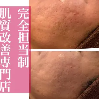 ニキビ特化型エステ 🍓最短で肌質改善のエステ・リラクイメージ