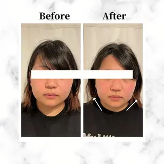 12Dハイフ💗 最強小顔のエステ・リラクイメージ