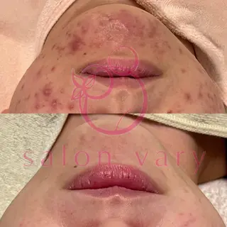 【ニキビ/肌管理】 salon varyのエステ・リラクイメージ