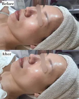 |ピーリング・毛穴| soina神楽坂のエステ・リラクイメージ