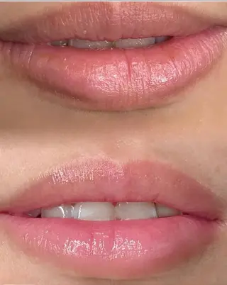 医療提携Ruby所属・医療提携Ruby小顔 ハーブピーリングのその他イメージ