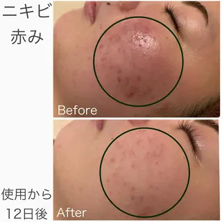 🔥3か月で肌革命 🔥ニキビ専門店のエステ・リラクイメージ