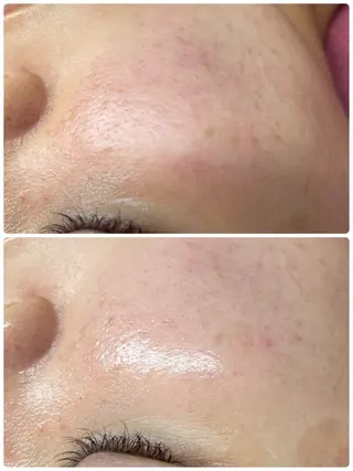 Chalon所属・REVI取扱・肌悩み 毛穴Chalonのエステ・リラクイメージ