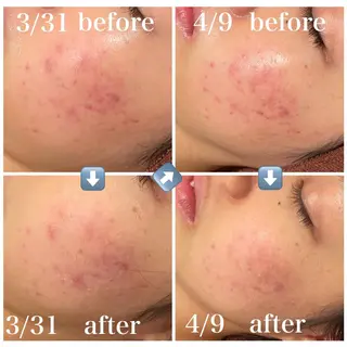 ニキビ特化型エステ 🍓最短で肌質改善のエステ・リラクイメージ