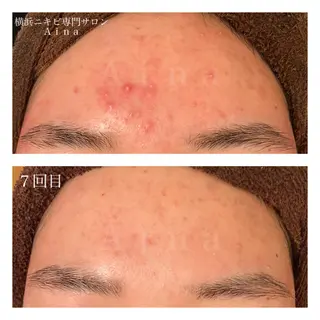 ミディアム カラー パーマ ヘアアレンジ メンズ キッズ ネイル マツエク・マツパ ニキビ跡専門サロン Ainaのエステ・リラクイメージ