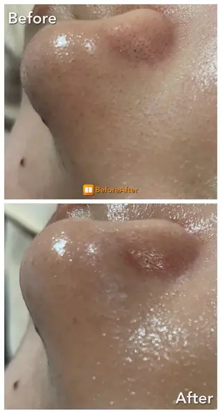 Meupニキビ専門店 背中/ハーブ/肌管理のその他イメージ