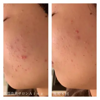 セミロング カラー パーマ ヘアアレンジ メンズ キッズ ネイル マツエク・マツパ ニキビ跡専門サロン Ainaのエステ・リラクイメージ