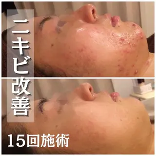 夏までに肌荒れ卒業 するサロン🌻のエステ・リラクイメージ