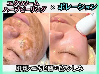 毛穴レス ハーブ& ワックス脱毛×光脱毛のエステ・リラクイメージ