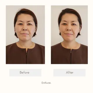 即効⚡小顔美容鍼🪡 むくみたるみ脂肪解消のエステ・リラクイメージ