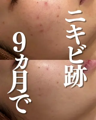 ダウンタイムなし🌷 優しい肌質改善のエステ・リラクイメージ