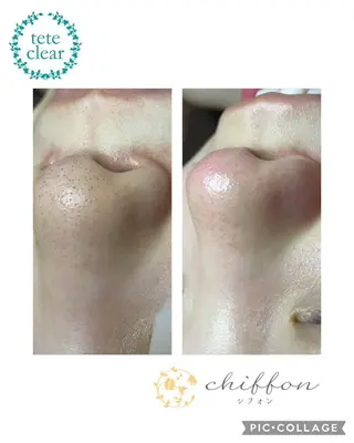 毛穴黒ずみ改善🥇 ✨シフォン豊田✨のエステ・リラクイメージ