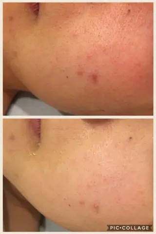 夏までに肌荒れ卒業 するサロン🌻のエステ・リラクイメージ