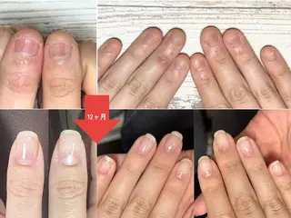 ネイル 深爪矯正・自爪育成 ネイルサロンアモまいのネイルデザイン