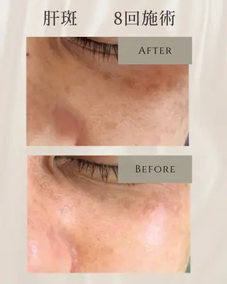 シミ毛穴|眉Wax THE  flowのエステ・リラクイメージ