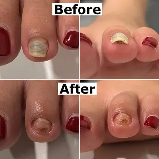 ネイル Mellow nail所属・巻爪無料モデル募集 ✨🦶MEGUMIのネイルデザイン